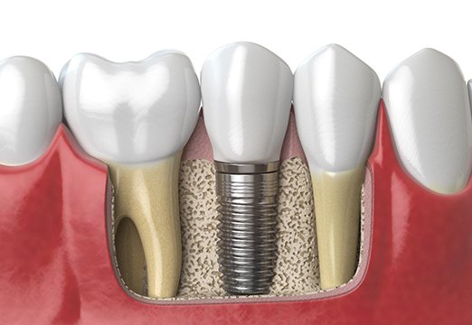 3D model of dental implants in Glenmont