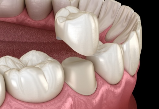 Animated smile during dental crown placement