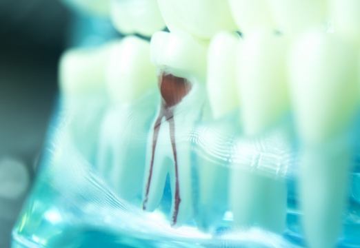 Model tooth showing the results of root canal therapy