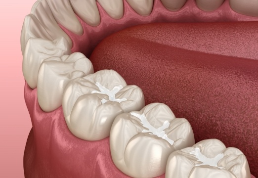 Animated teeth with dental sealants