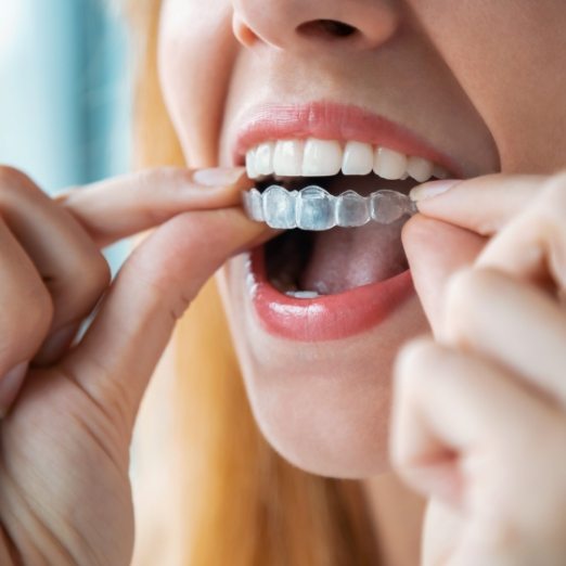 Dental patient placing ClearCorrect orthodontic aligner tray