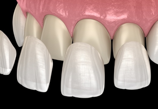 Animated smile during cosmetic dental bonding treatment