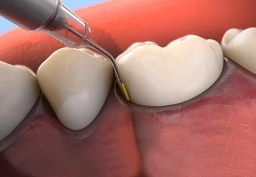 Animated smile during antibiotic therapy treatment