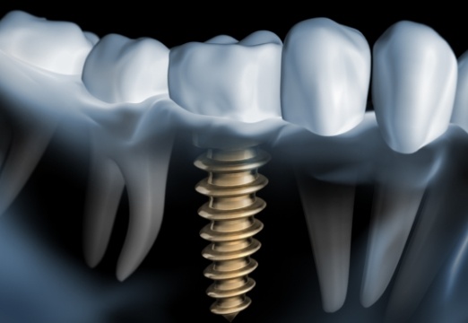 Animated smile with dental implant supported dental crown