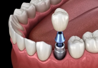 Animated smile during dental implant supported dental crown placement