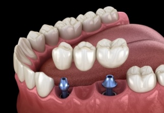 Animated smile during dental implant supported fixed bridge placement