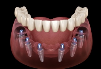 Animated smile during dental implant supported dentures placement