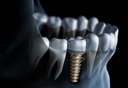 Animated smile with dental implant supported dental crown