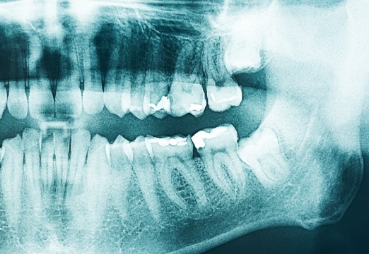 Digital dental x-rays
