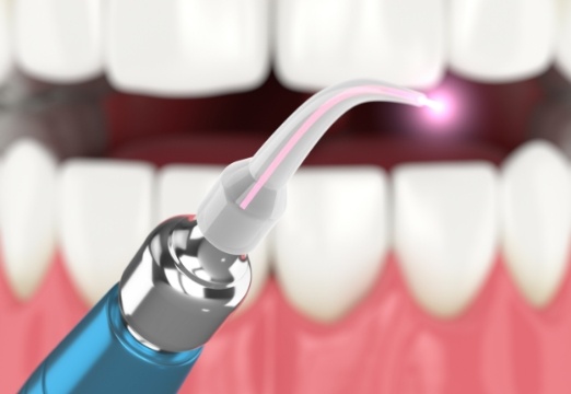 Animated smile and soft tissue laser dentistry tool